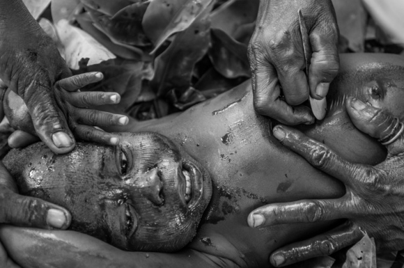 Scarification