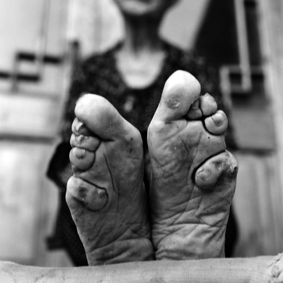 Zhao Hua Hong, bound feet