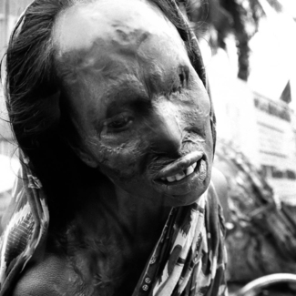 Acid Attack in Bangladesh