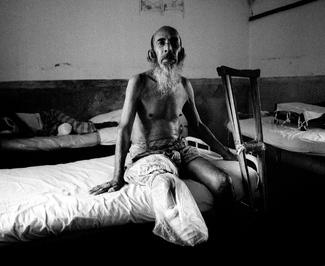 Old man with leprosy