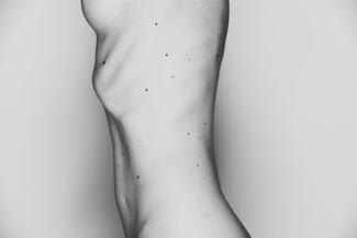 Nevus 1