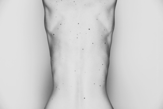 Nevus 2