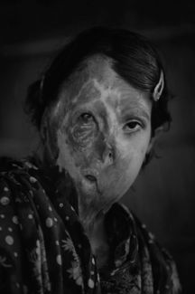 burnt women (6)