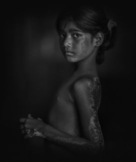 burnt women (1)
