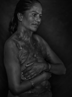 burnt women (3)