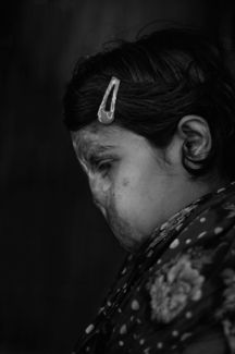 burnt women (5)