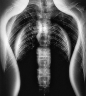 Xray Angel