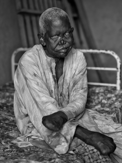 Leprosy
