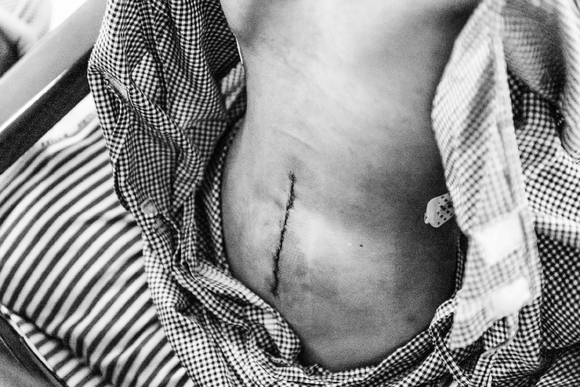 Surgical Scar
