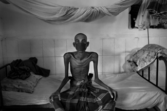 Tuberculosis in Bangladesh