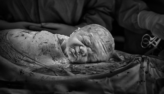 Gentle Caesarean Birth Gentle Caesarean Birth