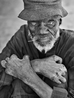 Man Suffering from Leprosy Man Suffering from Leprosy