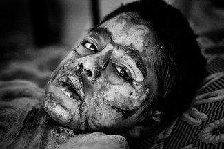 Victims of Petrol Bomb  Victims of Petrol Bomb